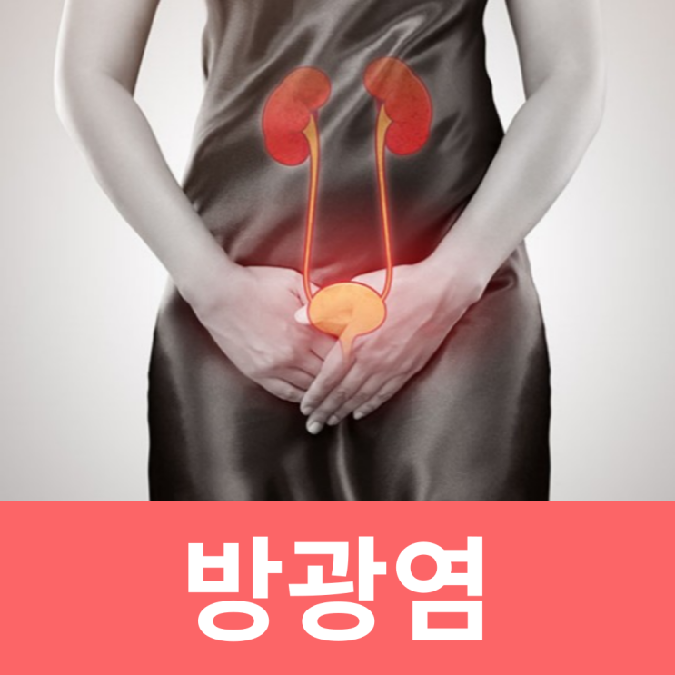  여자 방광염 증상 관계후 방광염 밀월성 예방 헤르페스