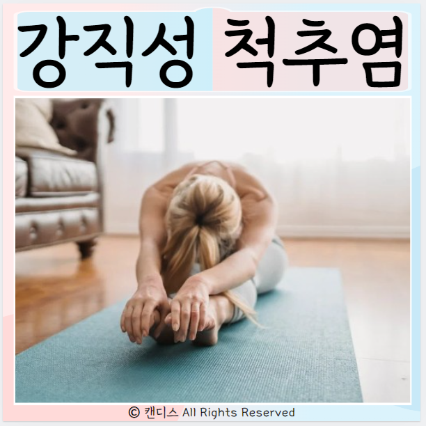  강직성 척추염 치료 원인 진단 특징