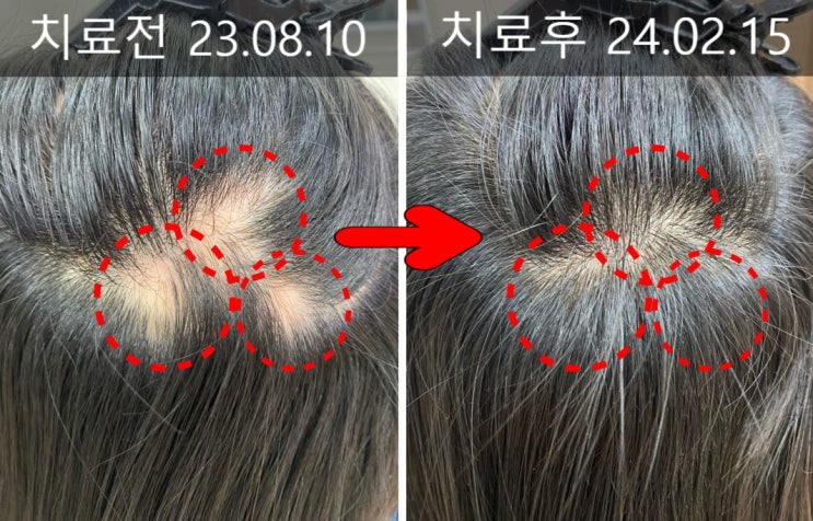  홍대 탈모병원, 2부위 이상 발생한 여자 원형탈모 사례