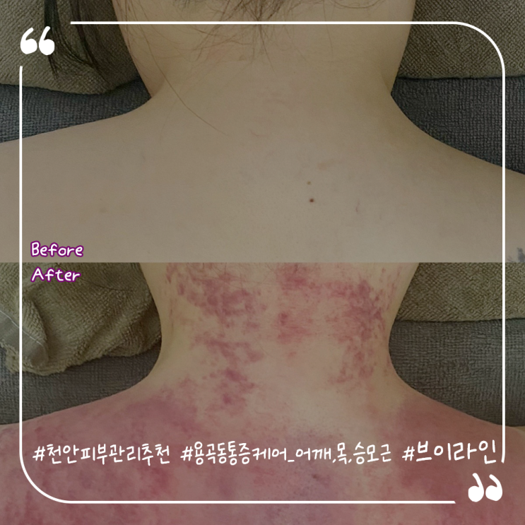  천안피부관리추천 용곡동승모근관리 용곡동브이라인 통증케어후기