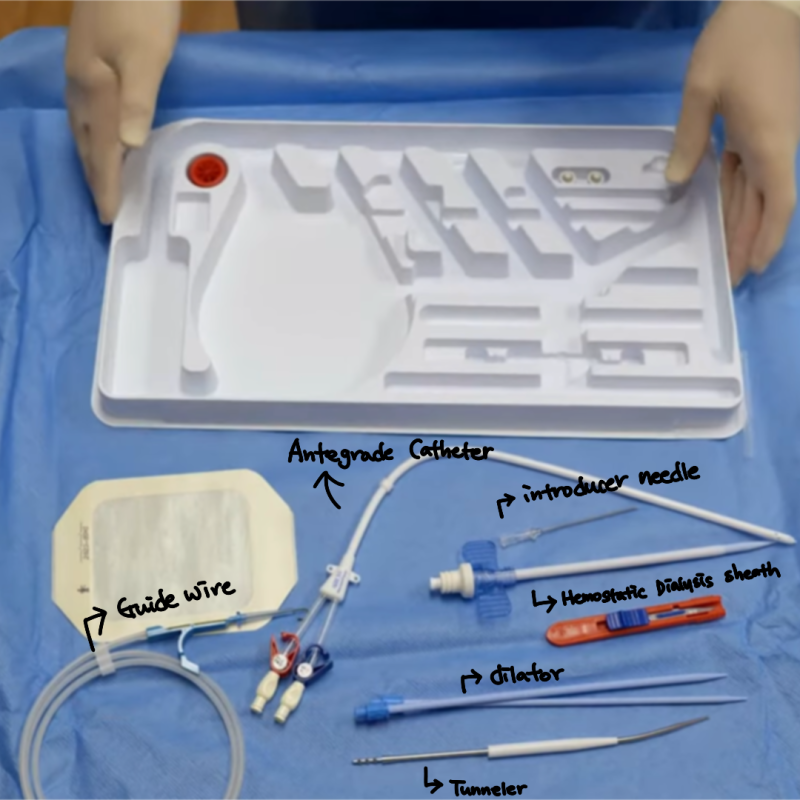 [수술 공부] TDC (Tunneled Hemodialysis Catheter) - perm cath ㅣ Port a cath ...