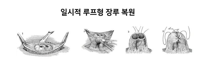 인공 장루 수술과 복원수술 및 부작용 : 네이버 블로그