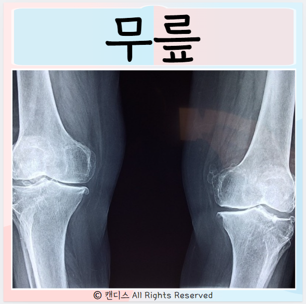  무릎인대 원인 염증 관절염 연골파열 슬개골 통증