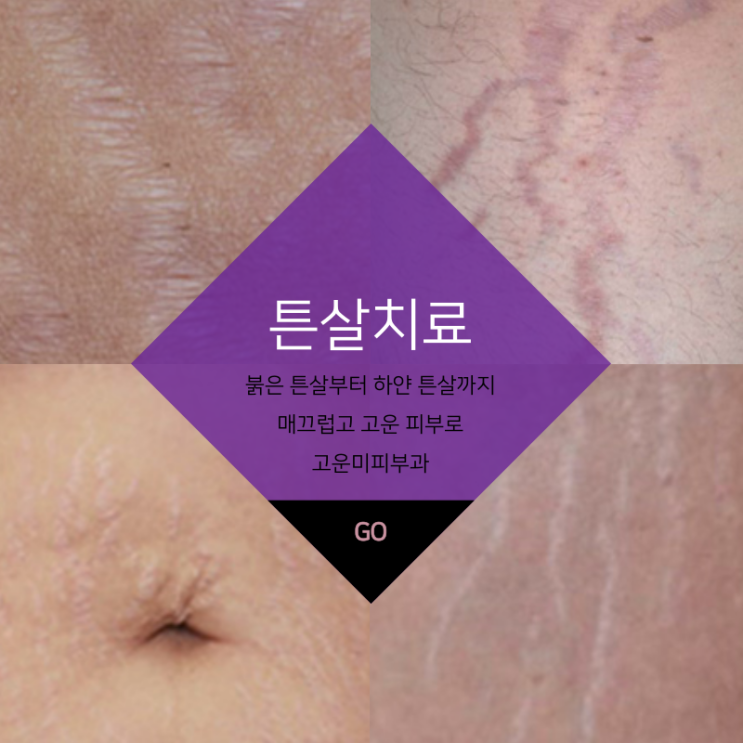  대구반월당튼살치료 피부과 전문의 여자 원장님이 직접 시술하는 큐어젯