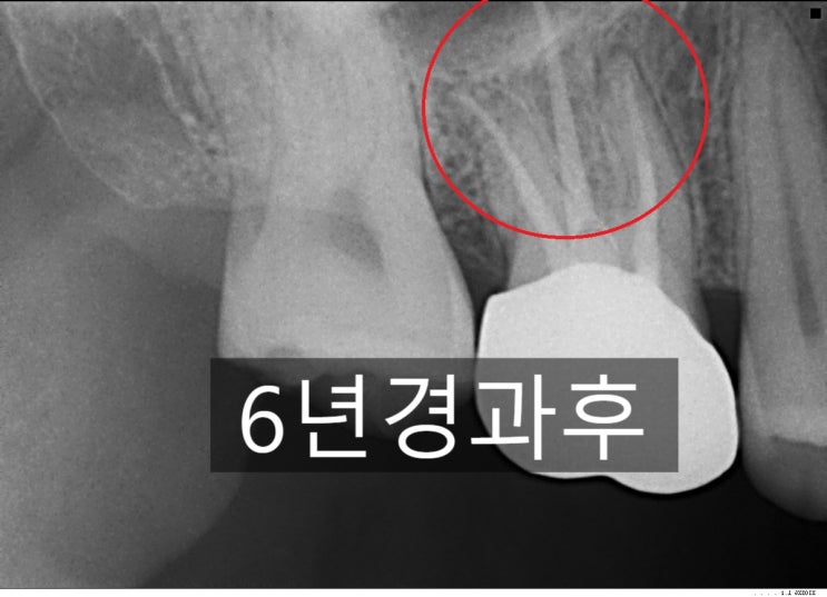  아픈 치아 재신경치료 6년후기(비용,기간,과정)