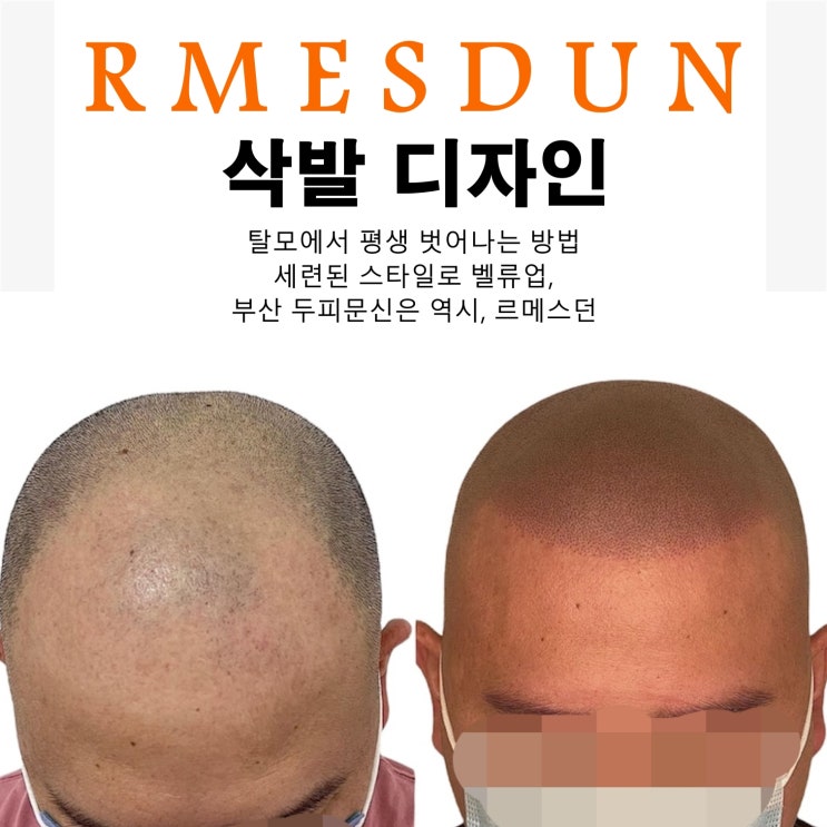  부산두피문신, 삭발이 무조건이라고 ?!!
