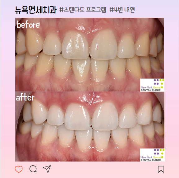  압구정치아미백 추천 누렁니 하얀치아로