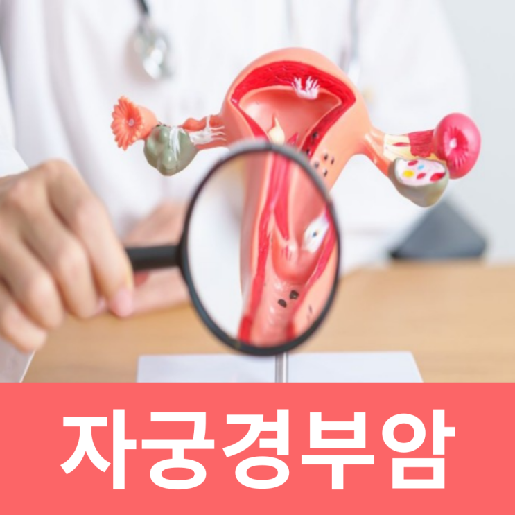  자궁경부암 전단계 1기증상 인유두종 바이러스 검사 주사 시기