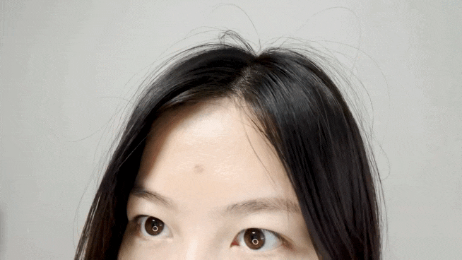 마포수두흉터치료 경과 후기 5회차 후기, 치료원리, 피부관리법 마포수두흉터치료 경과 후기 5회차 후기, 치료원리, 피부관리법