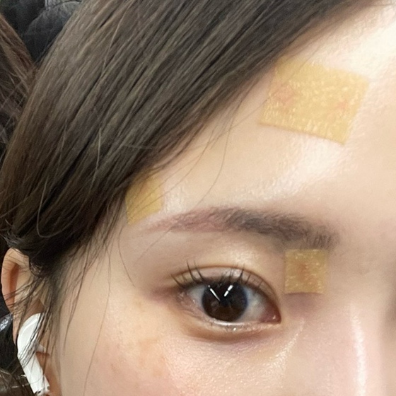  얼굴 봉합수술 후기-5탄(흉터 레이저/흉터관리 세벨리아 엘씨이밤크림/끝이 보이지 않는 치료 예정..)