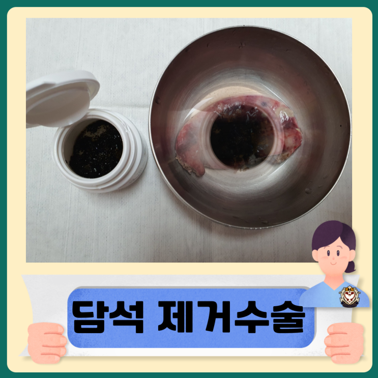  담석 제거수술 입원 복강경 개복 수술 방법