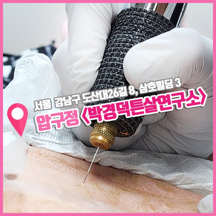  압구정피부관리 복부 튼살레이저 박경덕 튼살연구소 첫 방문 후기
