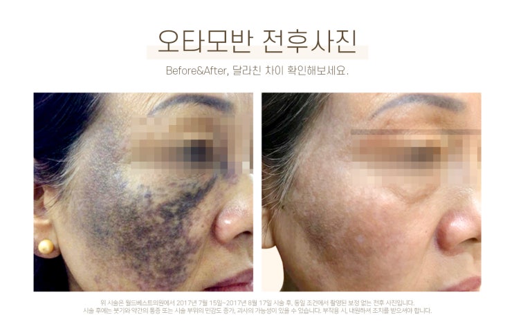  김포오타모반 치료 잘하는 섬세한 병원 찾으신다면? 장기동피부과