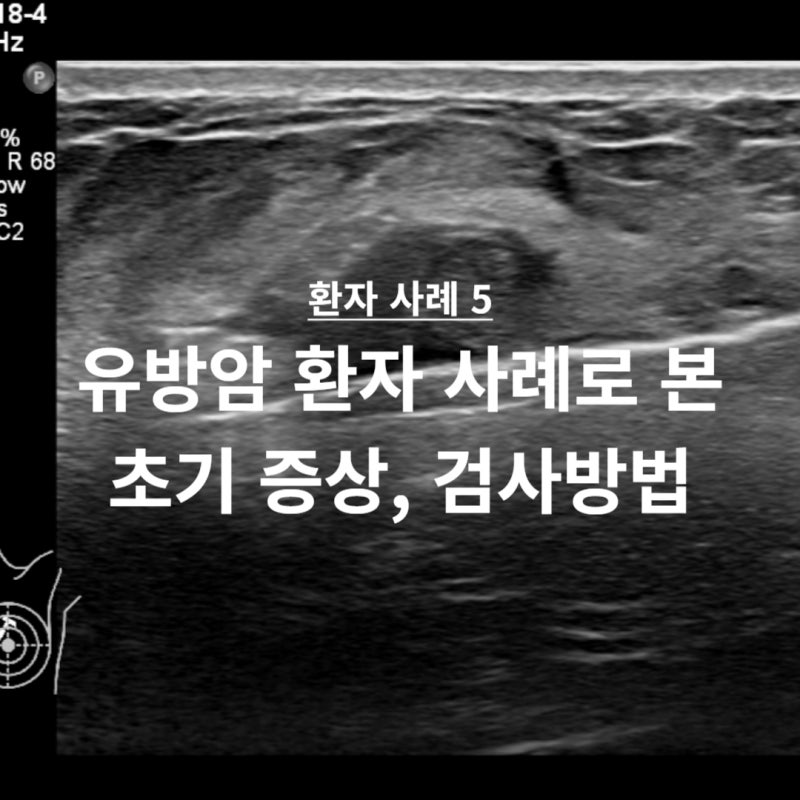 유방암 환자 실제 사례로 본 초기 증상, 검사방법 l 위례 유방외과