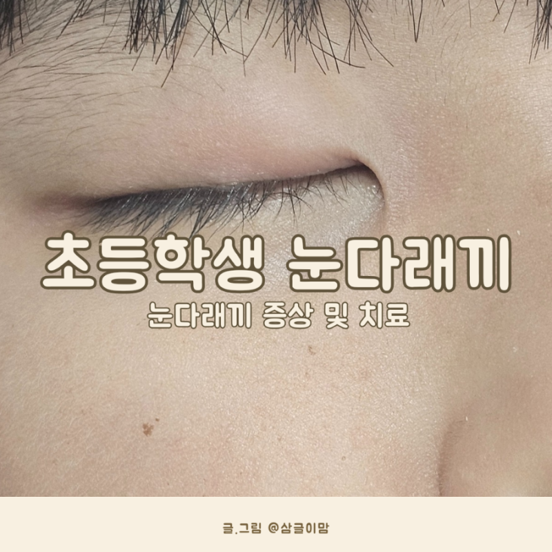 초등학생 눈다래끼 원인과 증상 및 눈다래끼 치료방법