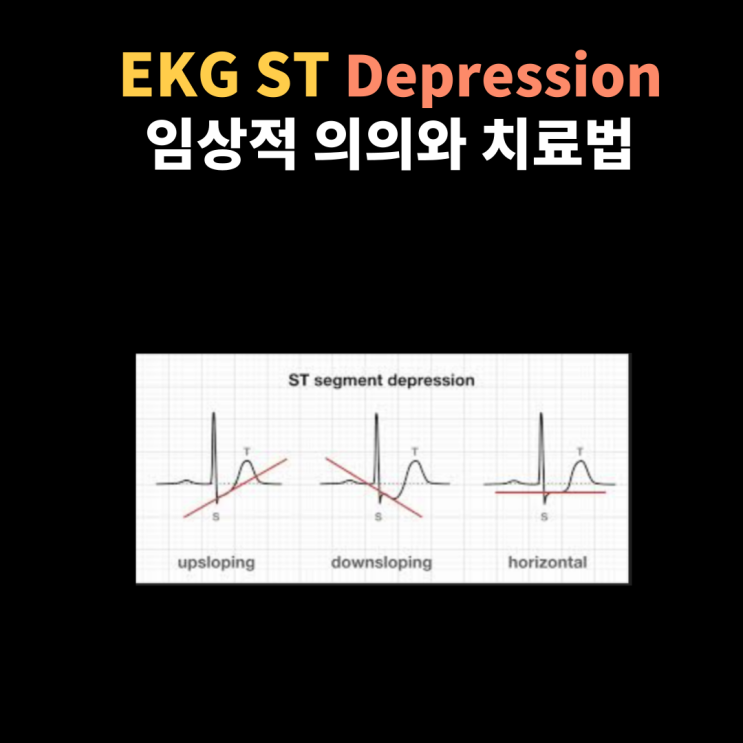  EKG ST depression (ST 하강) : 임상적 의미와 치료에 대해~
