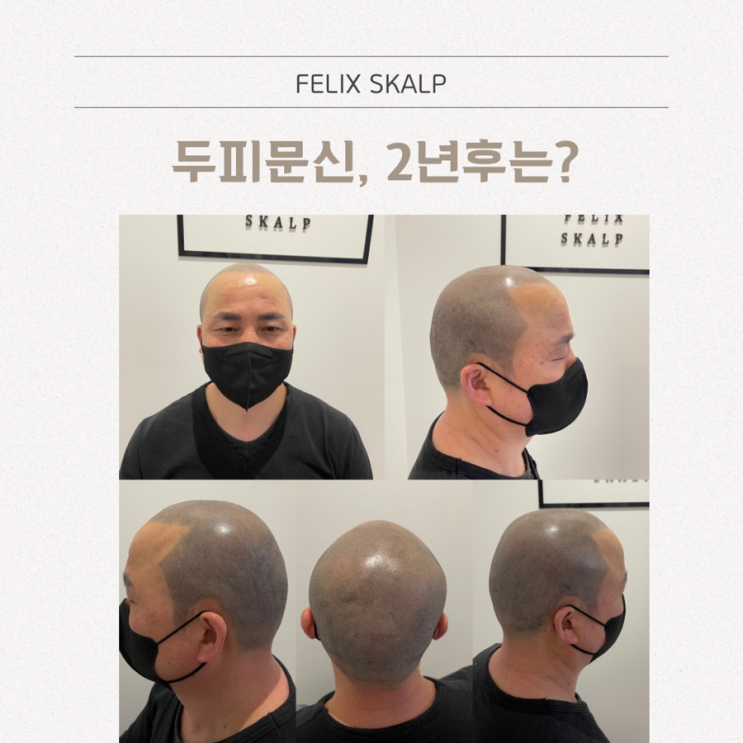  구래동 두피문신 2년후 후기는?