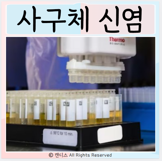  사구체신염 치료 증상 만성 원인