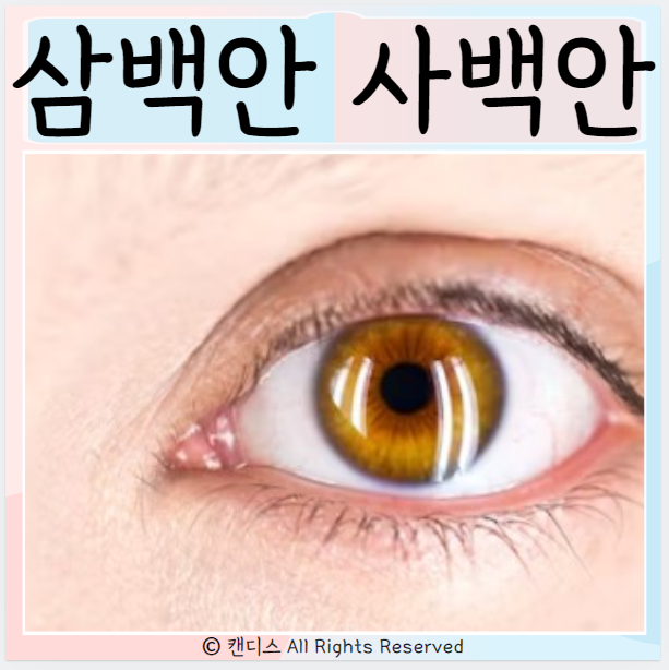  삼백안 관상 원인 사백안 눈관상