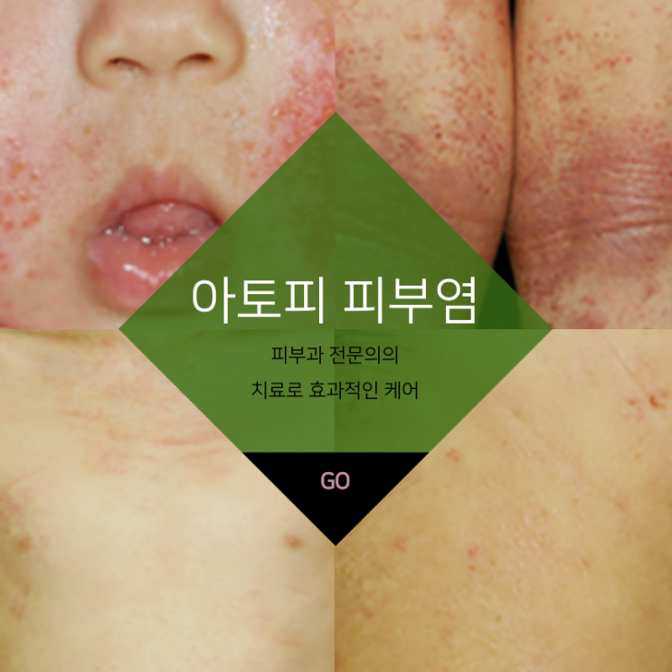  대구반월당아토피치료 만성 재발하는 아토피피부염 꾸준한 관리가 중요합니다