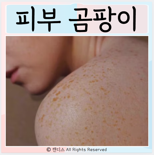  피부곰팡이 어우러기 전염 원인 치료 증상