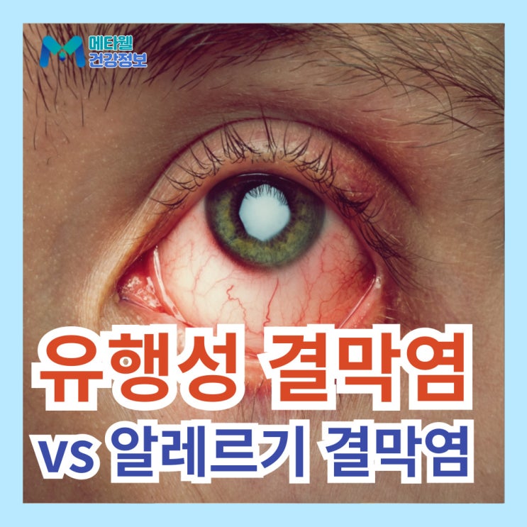 유행성 결막염 증상, 원인, 전염성, 예방법 vs 알레르기 결막염 차이