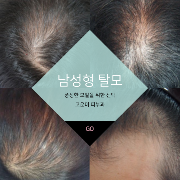  대구반월당탈모치료 고운미 피부과의 진행 타입별 체계적 모발 성장 치료