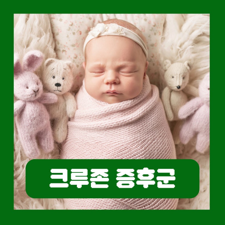  크루존 증후군 원인 안면 기형 유전 증상 치료