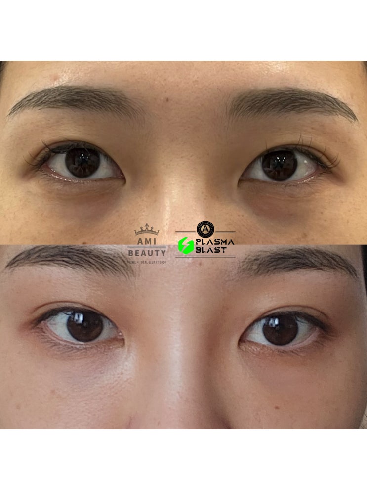  대구 플라즈마 쌍꺼풀 짝눈 쳐진눈 꺼진눈 교정 !!!부작용 없이 예뻐지는 방법!!!