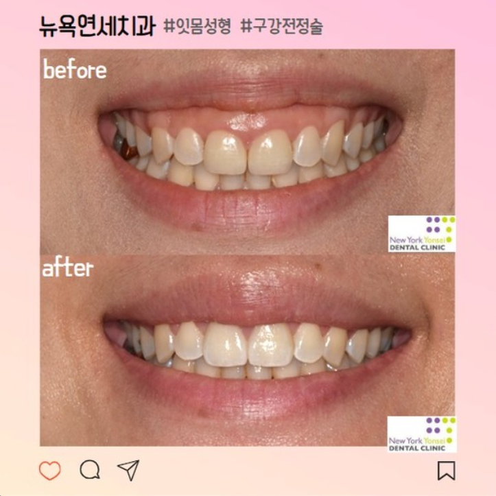 웃을 때 잇몸 노출 심한 거미스마일 원인과 잇몸성형 방법