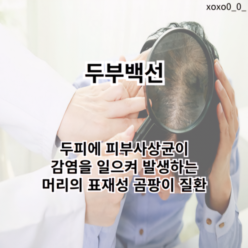 두부백선 원인 증상 치료