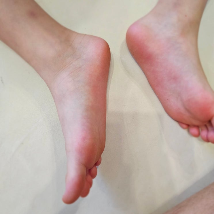  텔라렌 어린이 깔창 아치톡 키즈 평발 교정