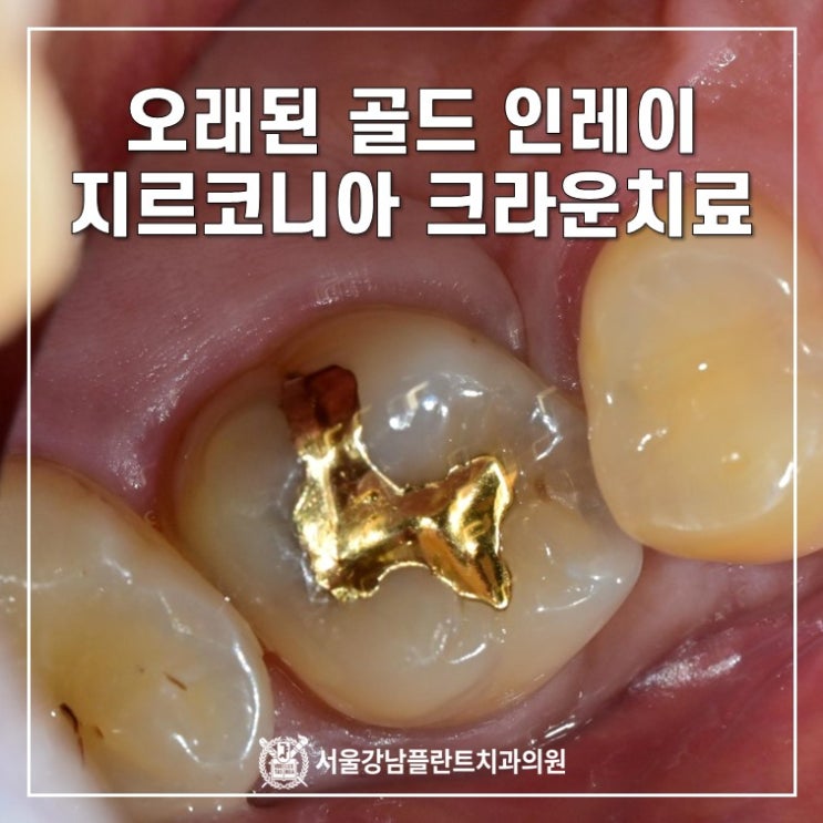 오래된 골드 인레이 - 지르코니아 크라운 치료 (feat. 쓰러진 치아 음식물 끼임)
