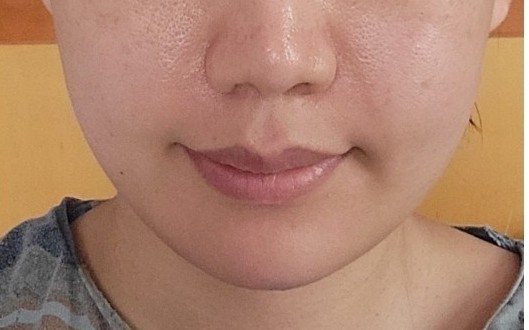  부산 서면 리프팅 어디? 꼬집리프팅-달리아스파