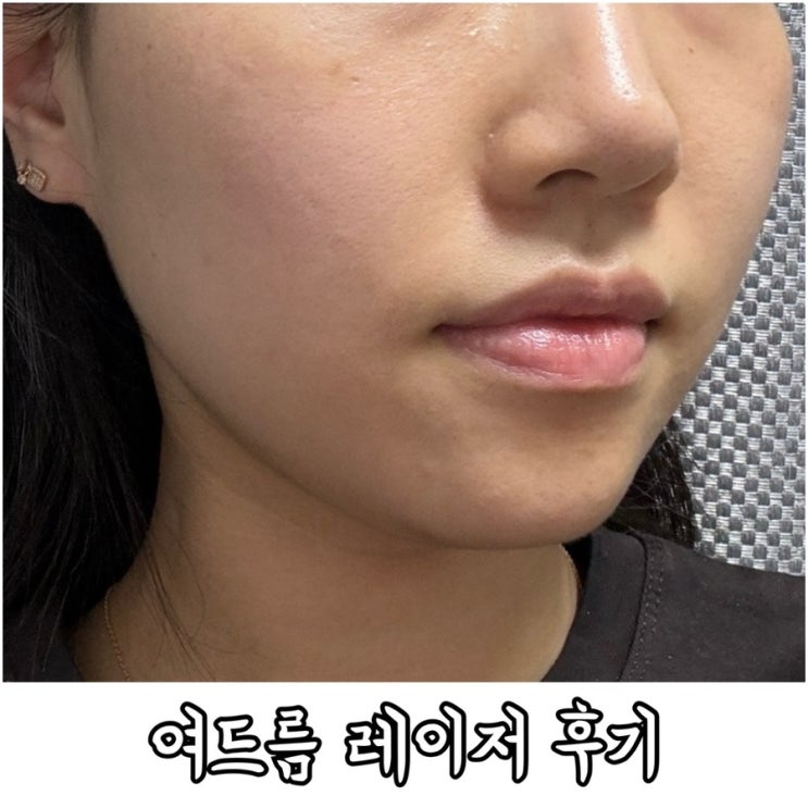  환절기 오돌토돌 피부 개선을 위해 다녀온 모공피부과 여드름 레이저 후기