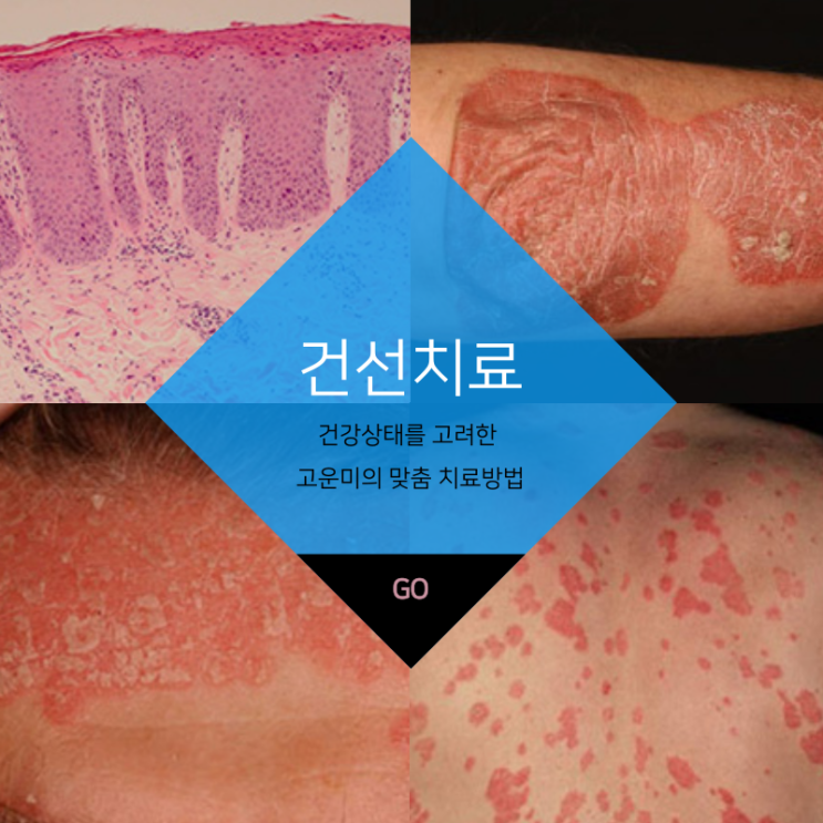  대구반월당건선치료 완치가 어려운 건선 꾸준한 관리가 중요합니다