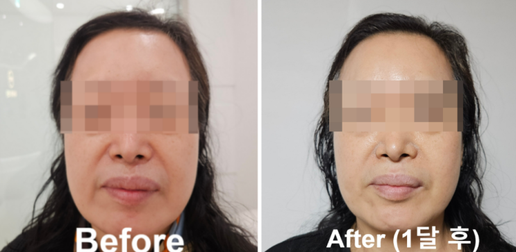  신사역피부과 티타늄리프팅 50대 엄마 후기