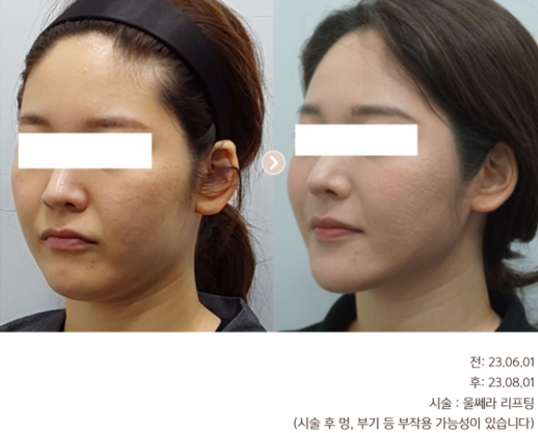 <b>런닝맨 송지효</b> 울쎄라 붓기? 600샷? 손해 보고 싶지 않다면 필독