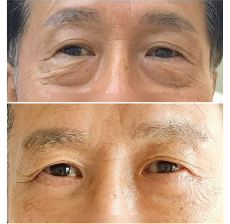 하안검수술 두 달차 후기 : 내돈내산 / 회복기간 / 흉터... 