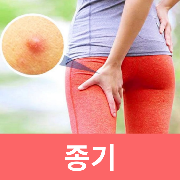  여자사타구니 종기 원인 치료 증상 종기고약