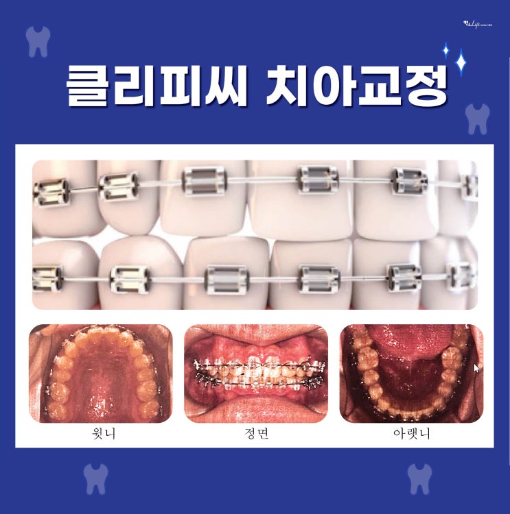  클리피씨 치아교정 1년 2개월 차 후기...