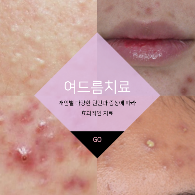  대구반월당여드름치료 조기 치료하지 않으면 흉터로 남을 수 있습니다