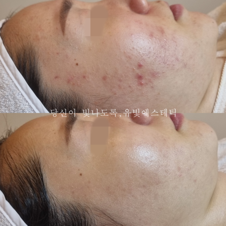 삼송 지축 원흥 좁쌀 여드름 없애기 케어
