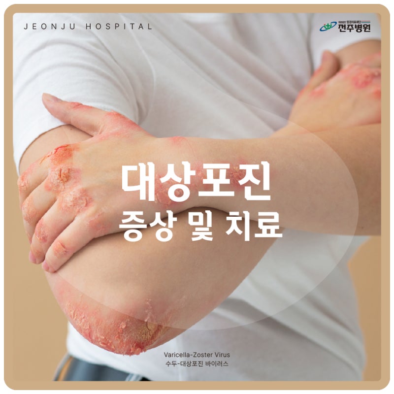 전주대상포진 원인 증상 및 예방