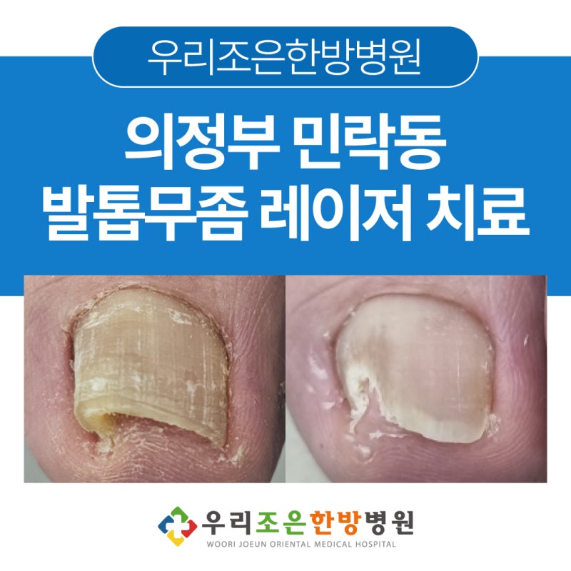 의정부 민락동 발톱무좀 레이저 치료 우리조은한방병원