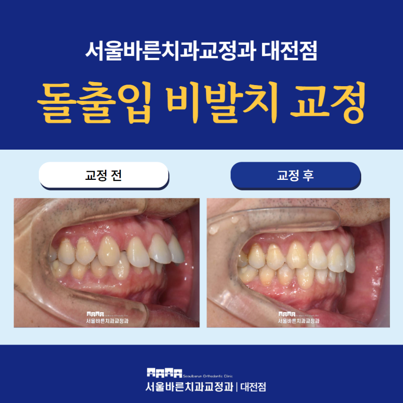 대전교정 추천방법을 알아볼까요?