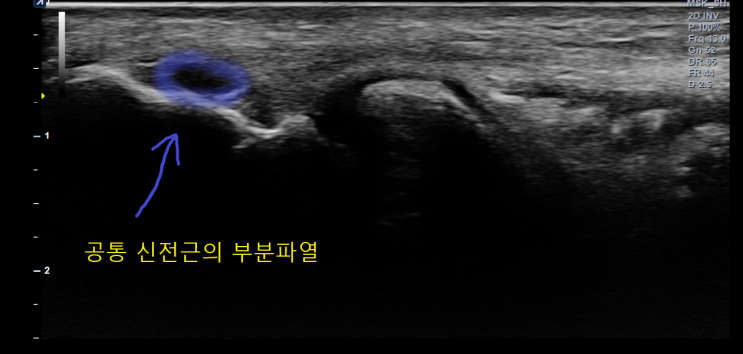  [대구프롤로치료] 꾸준하게 치료가 필요한 OO엘보우