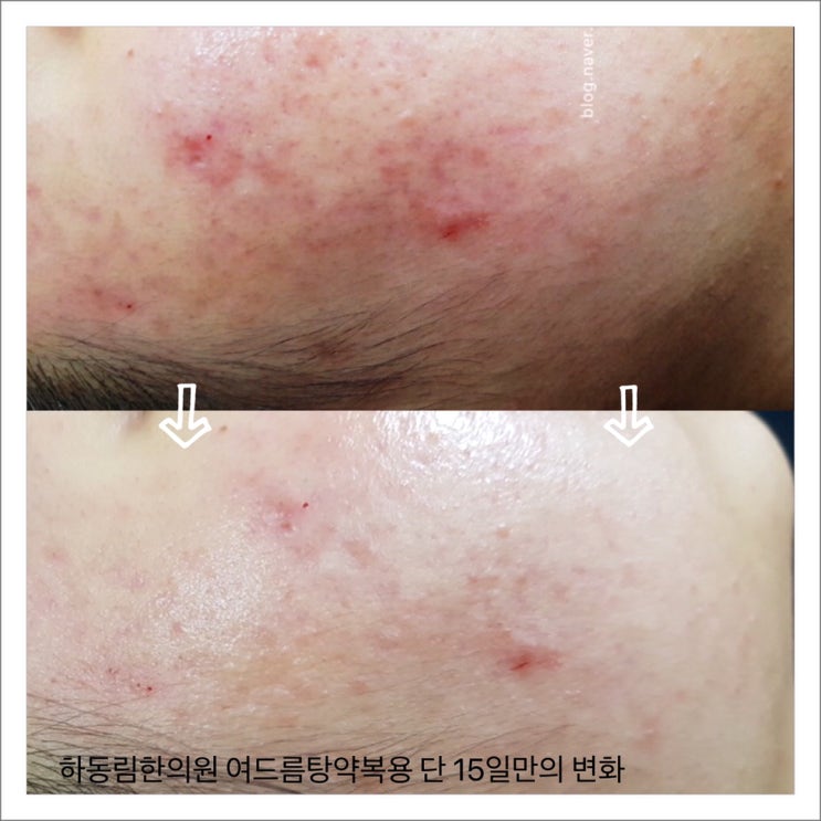  여드름 치료 20일 만에 빠른 효과, 19세 여학생 사례