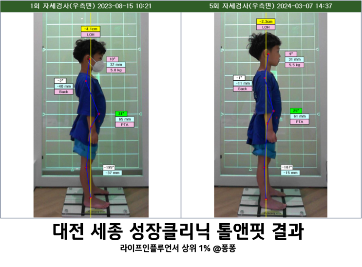  대전 세종 성장클리닉 톨앤핏 아이 6세 7세 키 예상키 숨은키 찾기 체형 분석 교정 관리