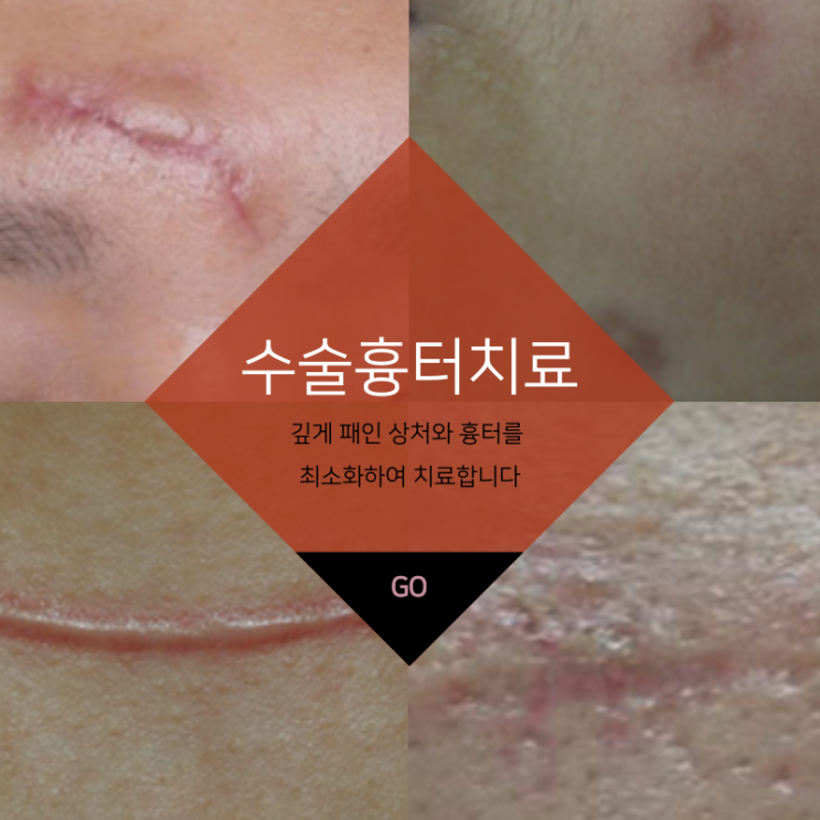  대구반월당수술흉터치료 빨리 치료를 시작하는 것이 중요합니다